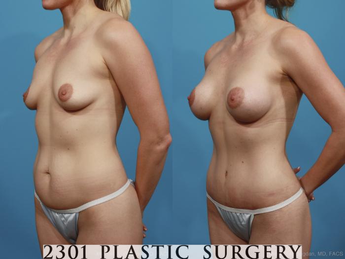 Before & After Silicone Implants Case 386 View #3 View in Fort Worth, Plano, & Frisco, Texas