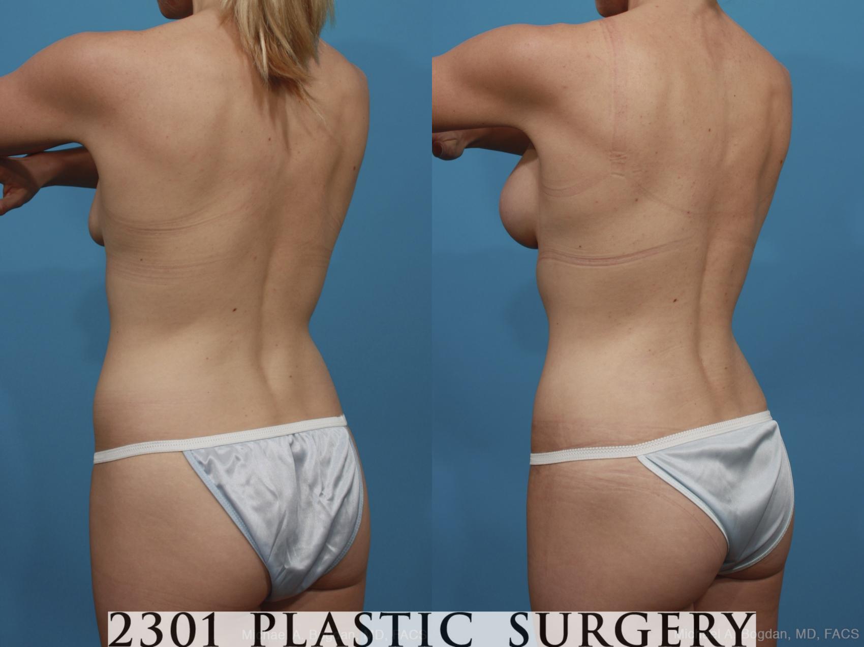 Before & After Silicone Implants Case 386 View #4 View in Fort Worth & Frisco, Texas