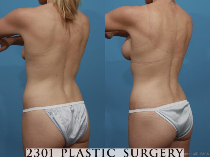 Before & After Silicone Implants Case 386 View #4 View in Fort Worth, Plano, & Frisco, Texas