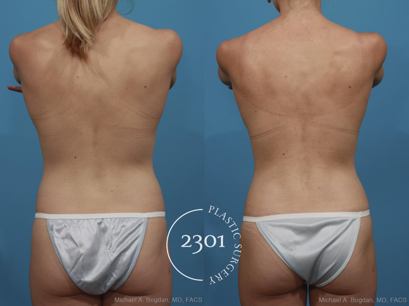 Before & After Silicone Implants Case 386 View #5 View in Fort Worth, Plano, & Frisco, Texas