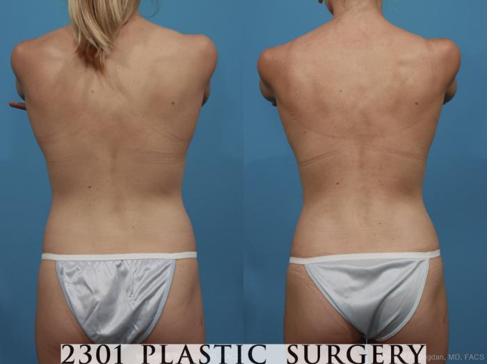 Before & After Silicone Implants Case 386 View #5 View in Fort Worth, Plano, & Frisco, Texas
