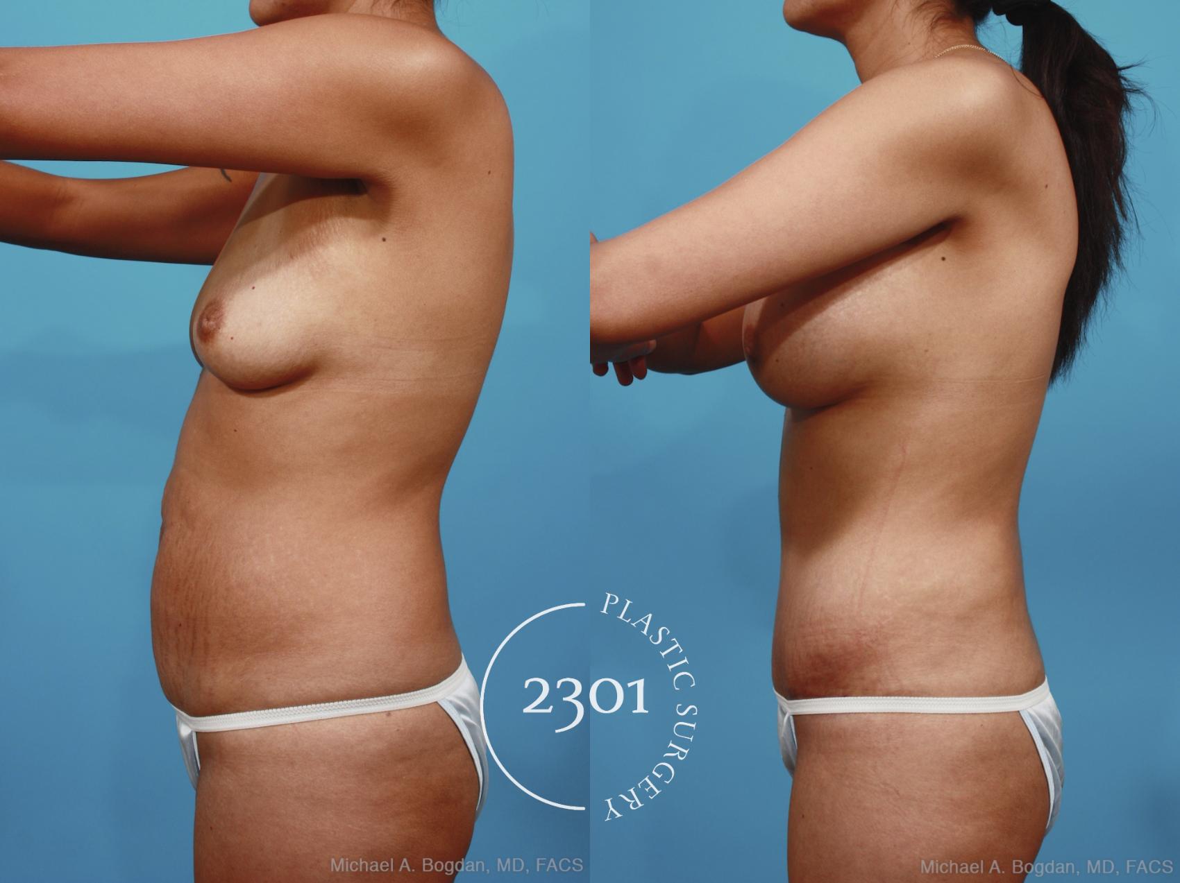 Before & After Mommy Makeover Case 398 View #2 View in Fort Worth, Plano, & Frisco, Texas