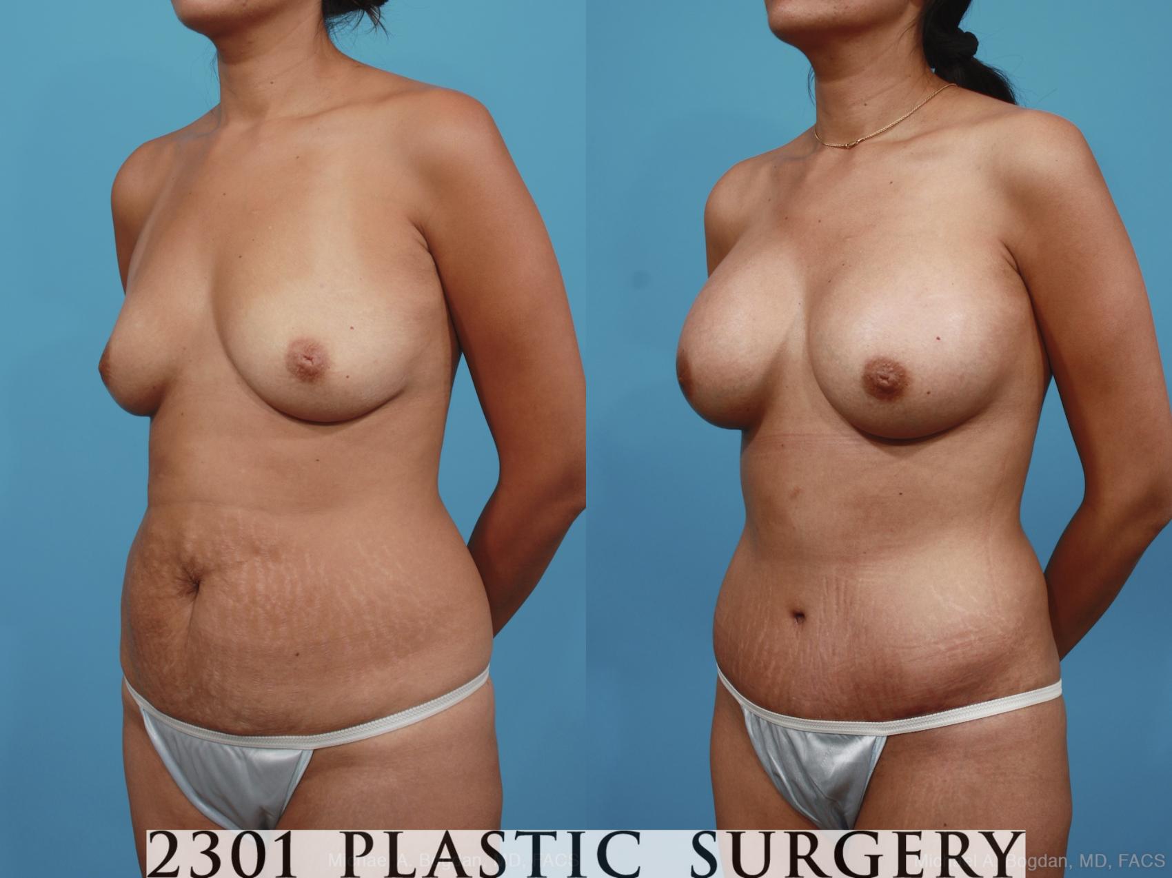 Before & After Mommy Makeover Case 398 View #3 View in Fort Worth & Frisco, Texas