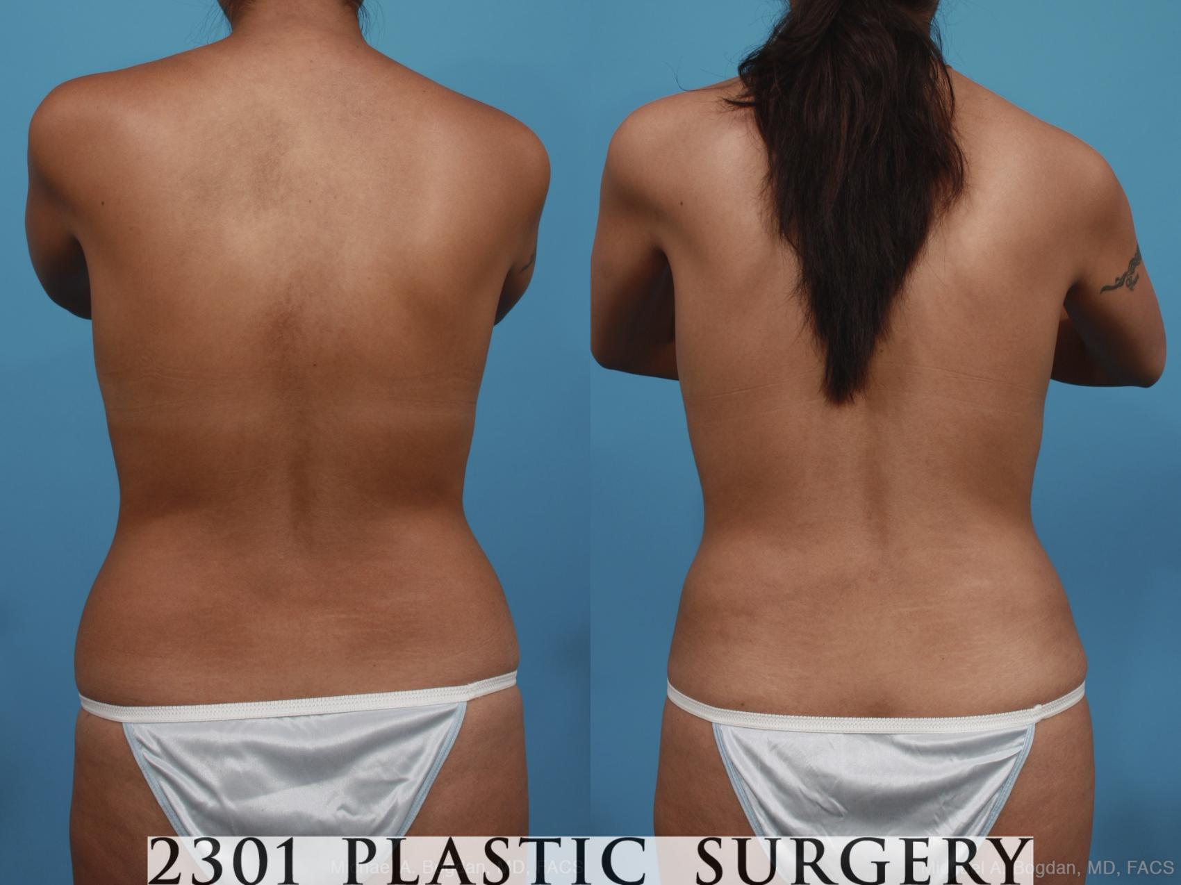 Before & After Mommy Makeover Case 398 View #5 View in Fort Worth & Frisco, Texas