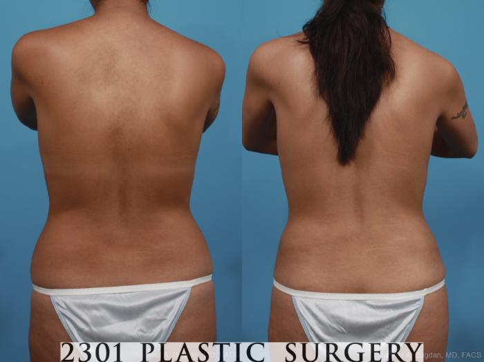 Before & After Mommy Makeover Case 398 View #5 View in Fort Worth, Plano, & Frisco, Texas