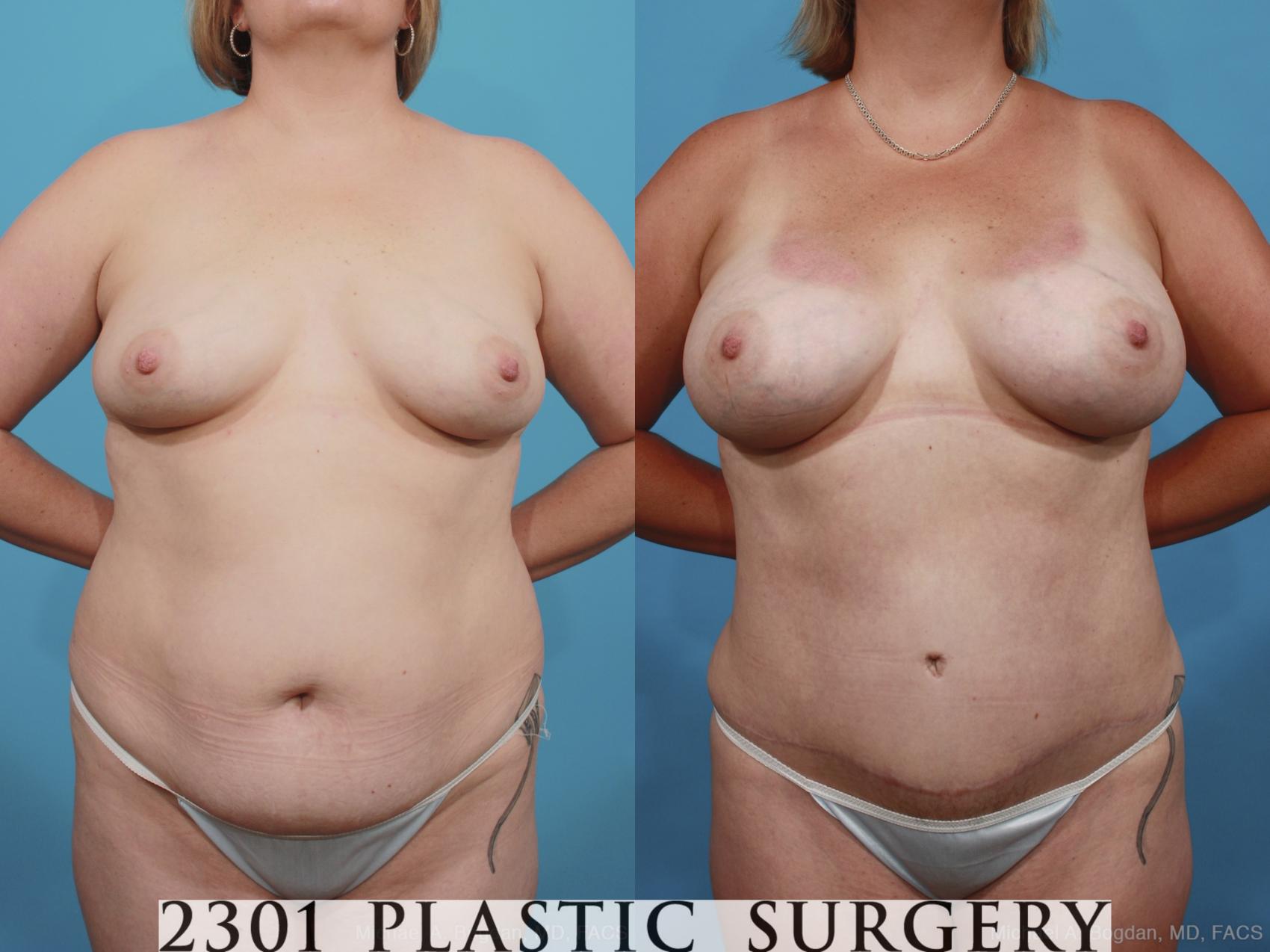 Before & After Mommy Makeover Case 399 View #1 View in Fort Worth, Plano, & Frisco, Texas