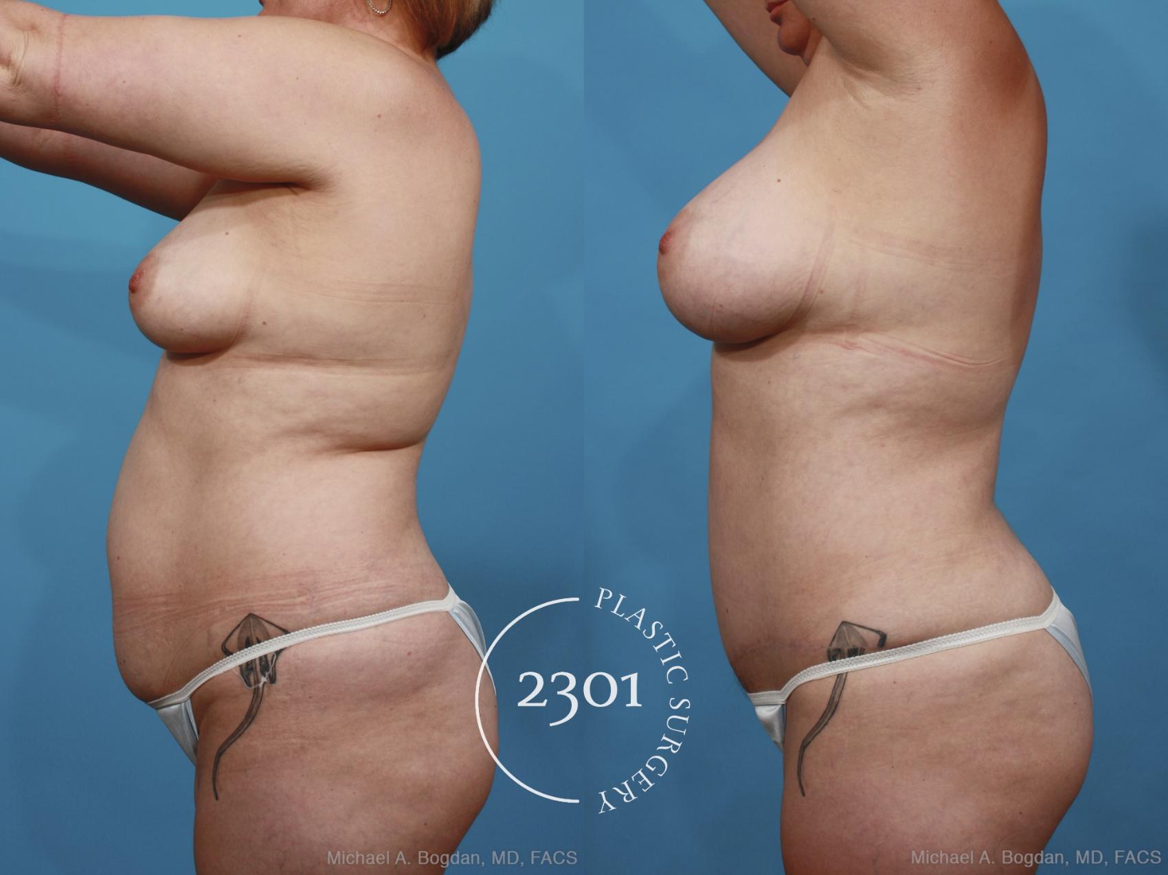 Before & After Mommy Makeover Case 399 View #2 View in Fort Worth, Plano, & Frisco, Texas
