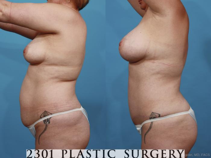 Before & After Breast Augmentation Case 399 View #2 View in Fort Worth, Plano, & Frisco, Texas
