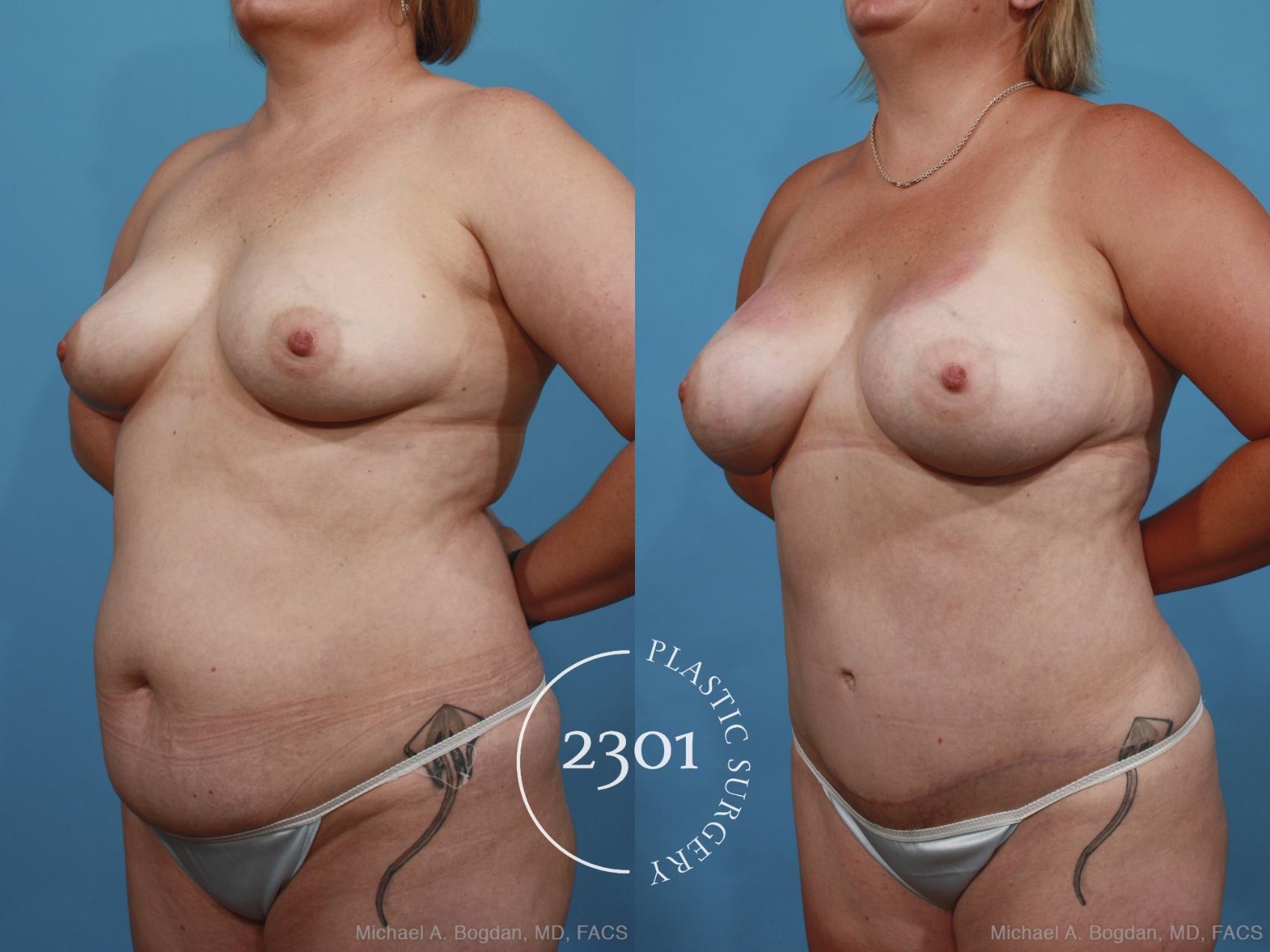 Before & After Mommy Makeover Case 399 View #3 View in Fort Worth, Plano, & Frisco, Texas