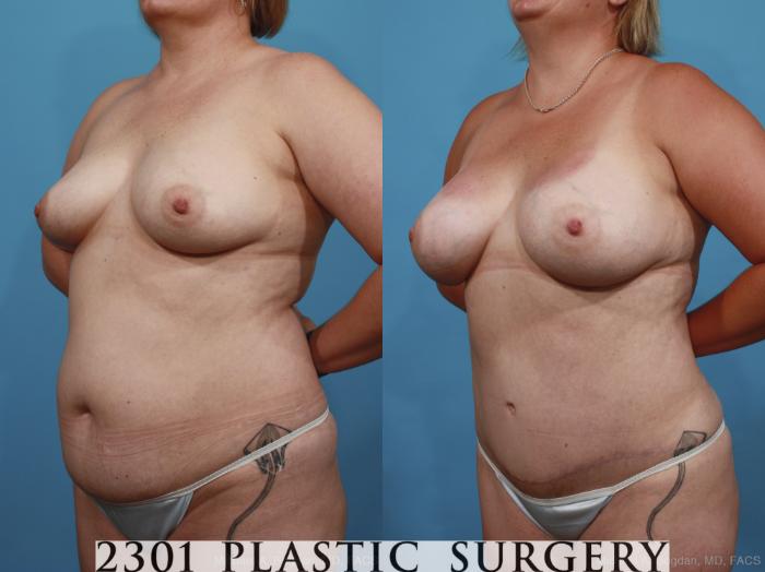 Before & After Breast Augmentation Case 399 View #3 View in Fort Worth, Plano, & Frisco, Texas