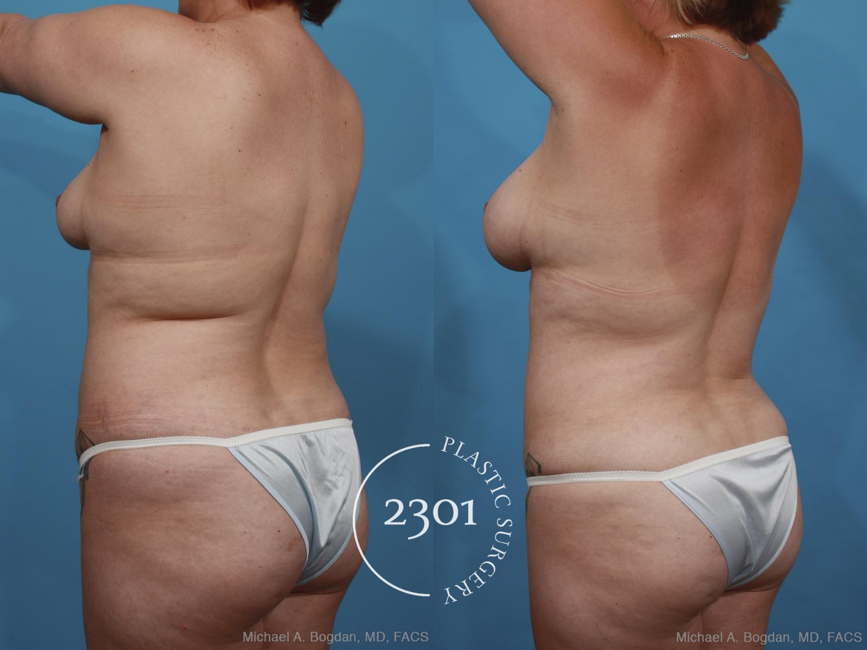 Before & After Mommy Makeover Case 399 View #4 View in Fort Worth, Plano, & Frisco, Texas