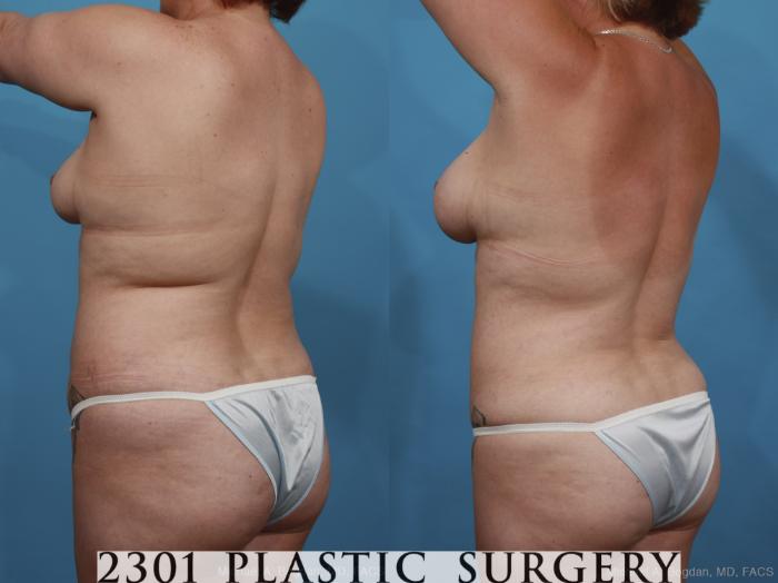 Before & After Breast Augmentation Case 399 View #4 View in Fort Worth, Plano, & Frisco, Texas