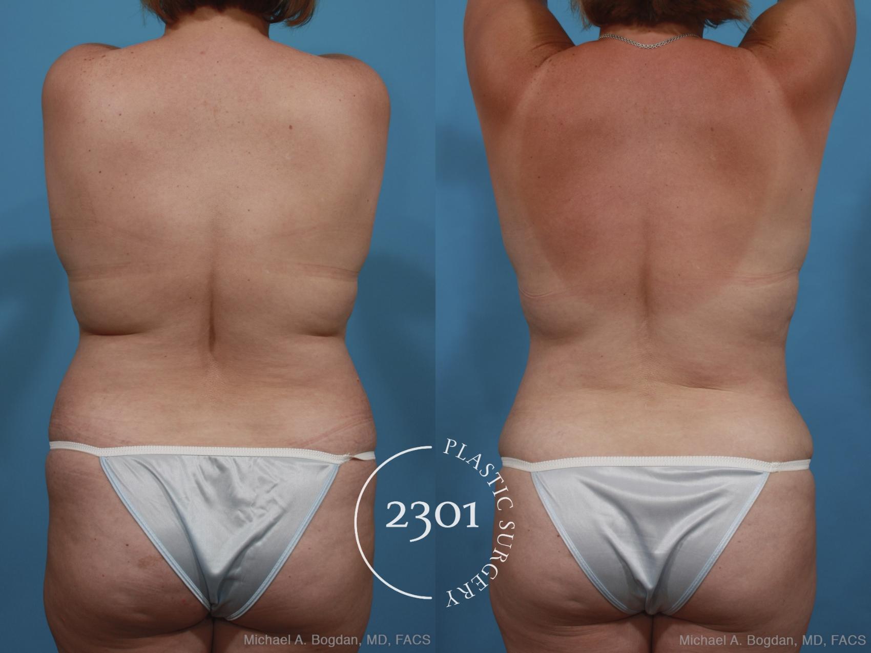 Before & After Mommy Makeover Case 399 View #5 View in Fort Worth, Plano, & Frisco, Texas