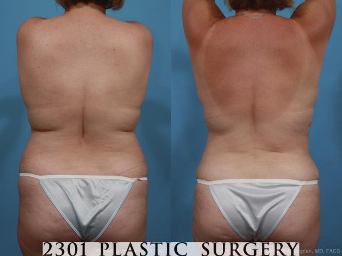 Before & After Mommy Makeover Case 399 View #5 View in Fort Worth, Plano, & Frisco, Texas