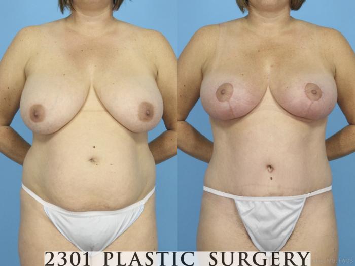 Before & After Mommy Makeover Case 422 View #1 View in Fort Worth, Plano, & Frisco, Texas