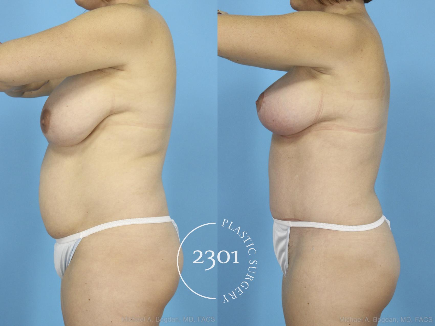 Before & After Mommy Makeover Case 422 View #2 View in Fort Worth, Plano, & Frisco, Texas