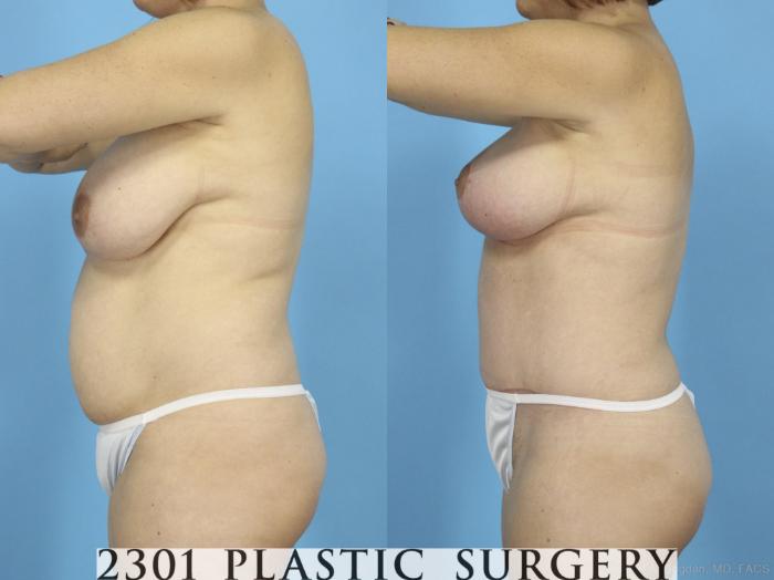 Before & After Breast Lift (Mastopexy) Case 422 View #2 View in Fort Worth, Plano, & Frisco, Texas