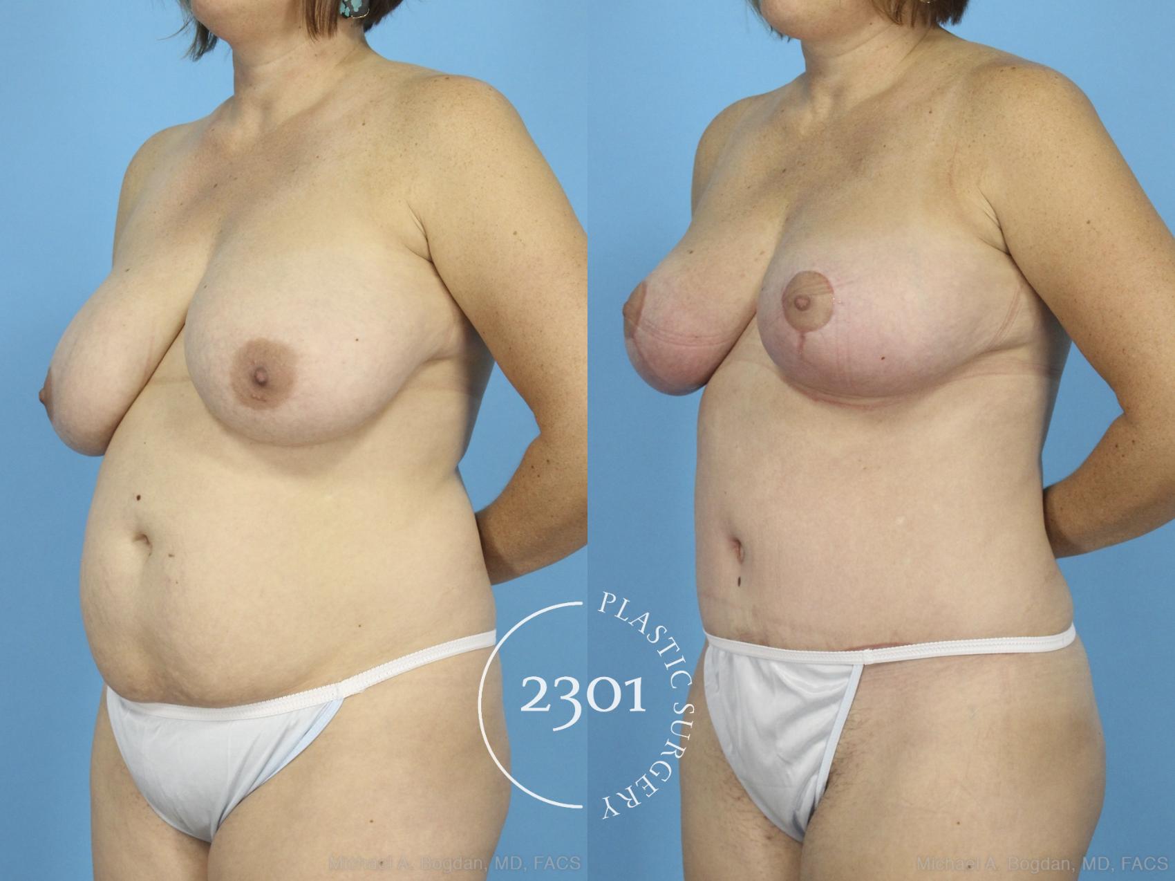 Before & After Mommy Makeover Case 422 View #3 View in Fort Worth, Plano, & Frisco, Texas