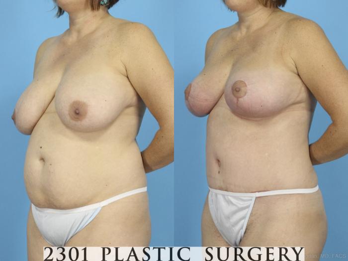 Before & After Breast Lift (Mastopexy) Case 422 View #3 View in Fort Worth, Plano, & Frisco, Texas