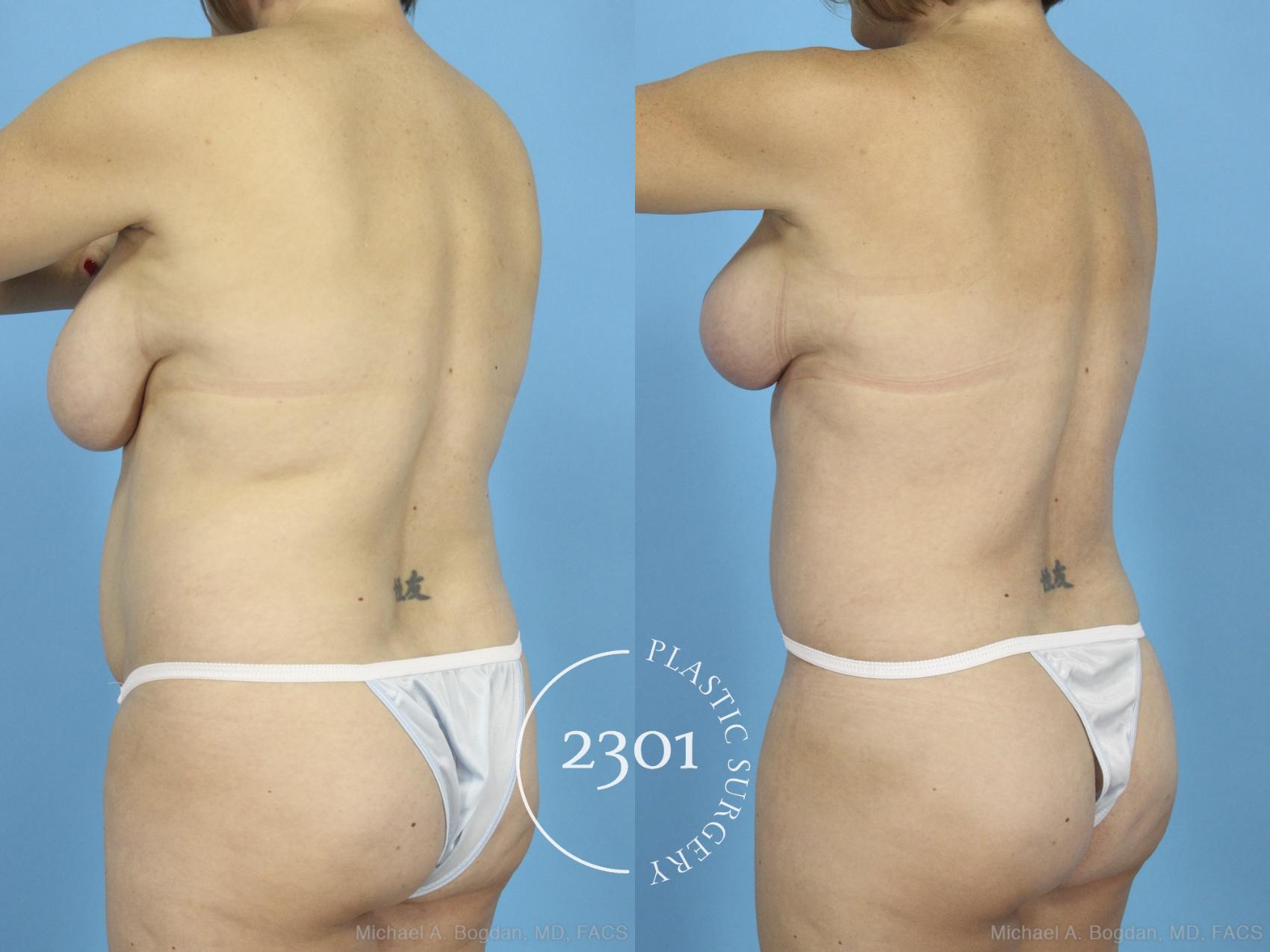 Before & After Mommy Makeover Case 422 View #4 View in Fort Worth, Plano, & Frisco, Texas