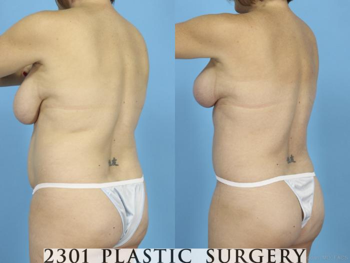Before & After Liposuction Case 422 View #4 View in Fort Worth, Plano, & Frisco, Texas