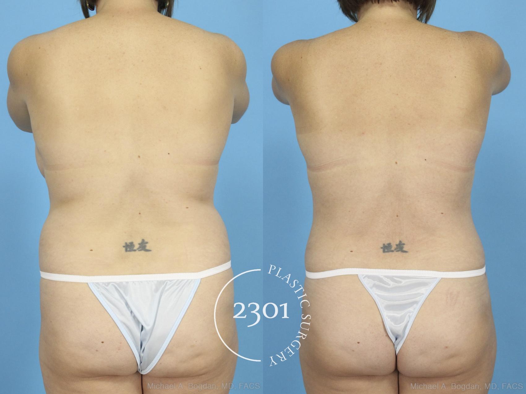 Before & After Mommy Makeover Case 422 View #5 View in Fort Worth, Plano, & Frisco, Texas