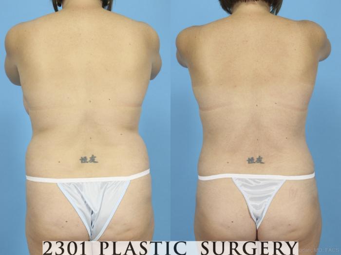Before & After Mommy Makeover Case 422 View #5 View in Fort Worth, Plano, & Frisco, Texas