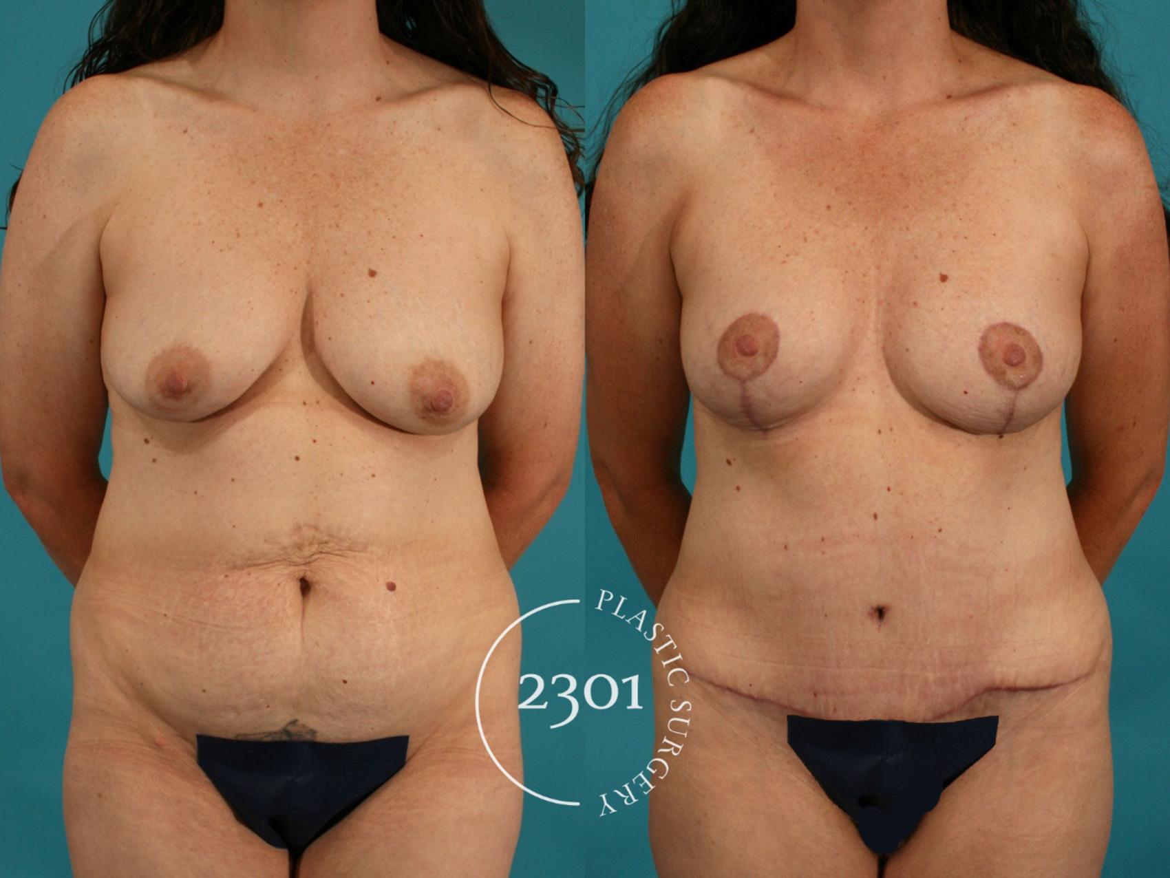 Before & After Breast Lift (Mastopexy) Case 43 View #4 View in Fort Worth, Plano, & Frisco, Texas