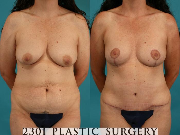 Before & After Tummy Tuck Case 43 View #4 View in Fort Worth, Plano, & Frisco, Texas