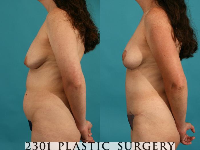 Before & After Tummy Tuck Case 43 View #6 View in Fort Worth, Plano, & Frisco, Texas