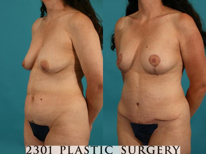Before & After Mommy Makeover Case 43 View #7 View in Fort Worth, Plano, & Frisco, Texas