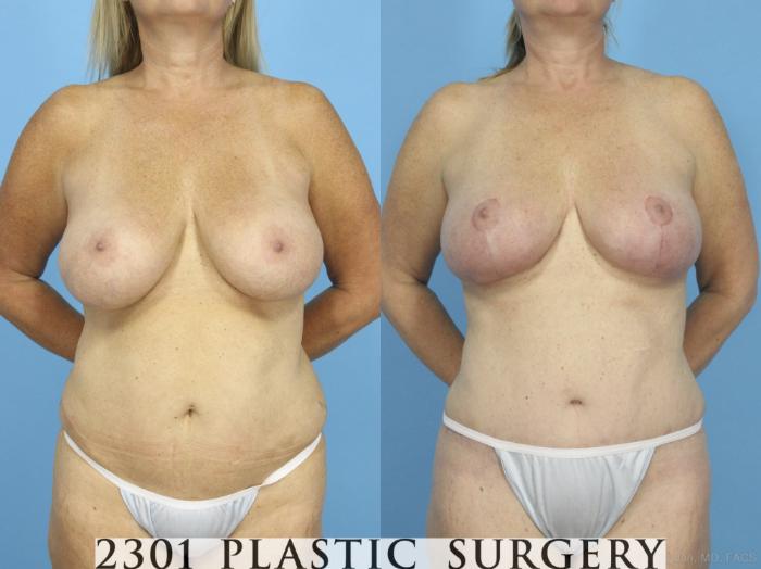 Before & After Liposuction Case 430 View #1 View in Fort Worth, Plano, & Frisco, Texas