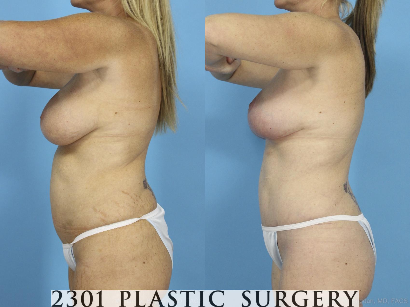Before & After Mommy Makeover Case 430 View #2 View in Fort Worth & Frisco, Texas