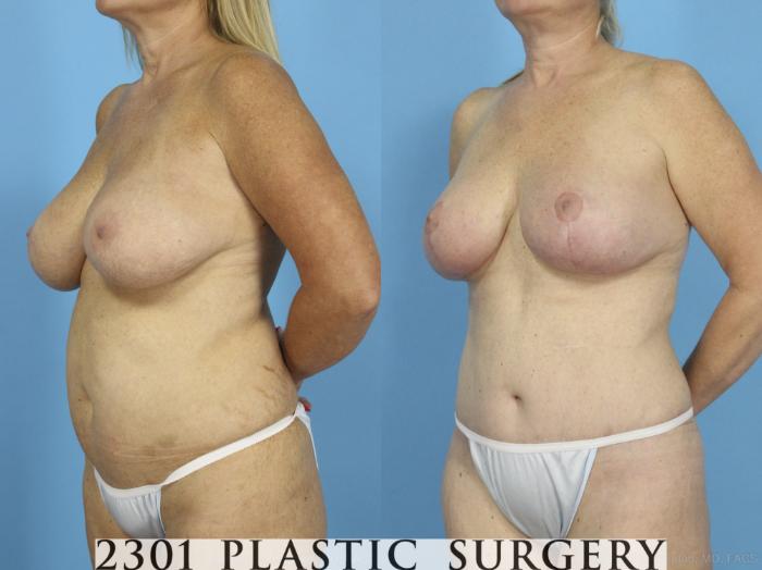 Before & After Breast Lift (Mastopexy) Case 430 View #3 View in Fort Worth, Plano, & Frisco, Texas