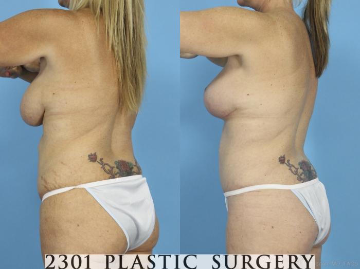 Before & After Mommy Makeover Case 430 View #4 View in Fort Worth, Plano, & Frisco, Texas