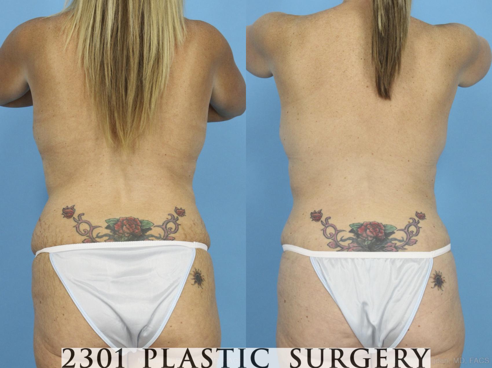 Before & After Mommy Makeover Case 430 View #5 View in Fort Worth & Frisco, Texas