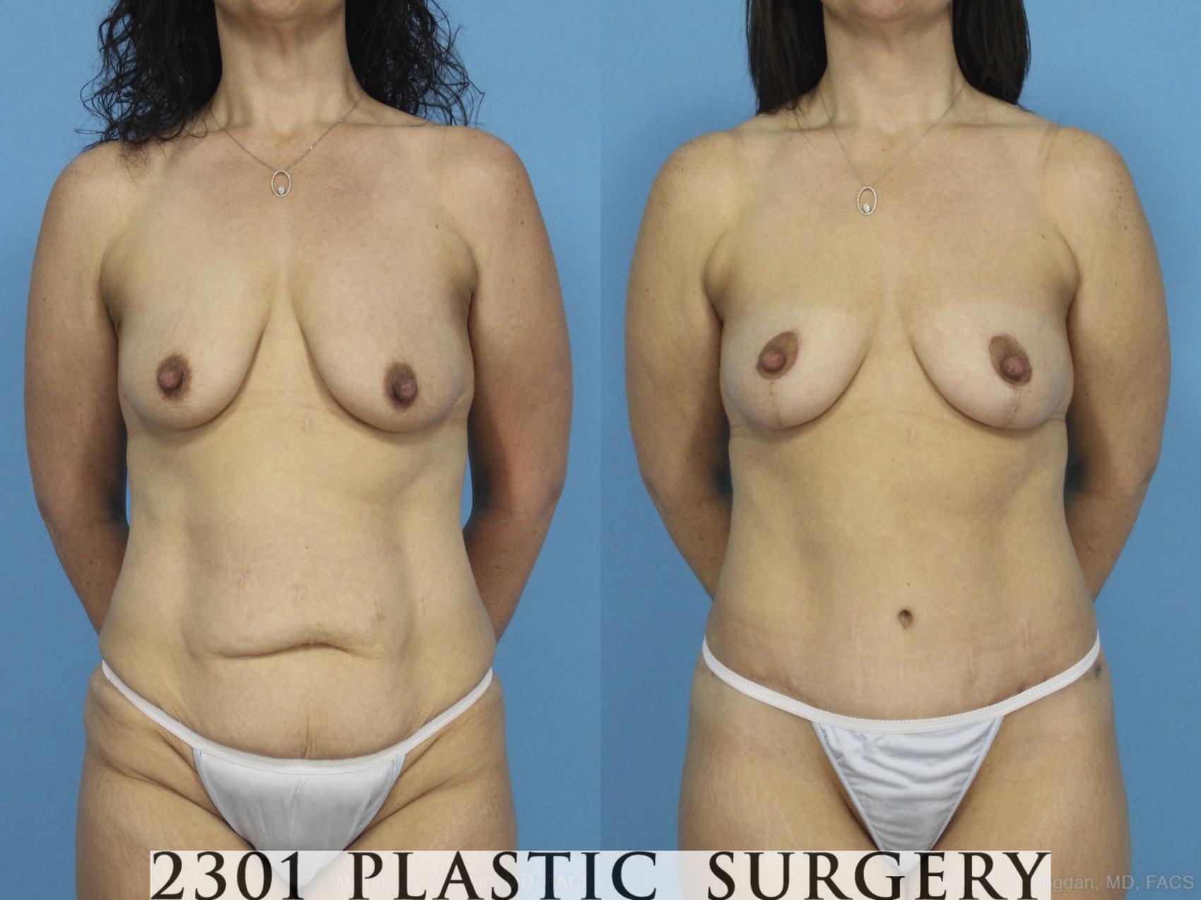 Before & After Breast Lift (Mastopexy) Case 435 View #1 View in Fort Worth, Plano, & Frisco, Texas