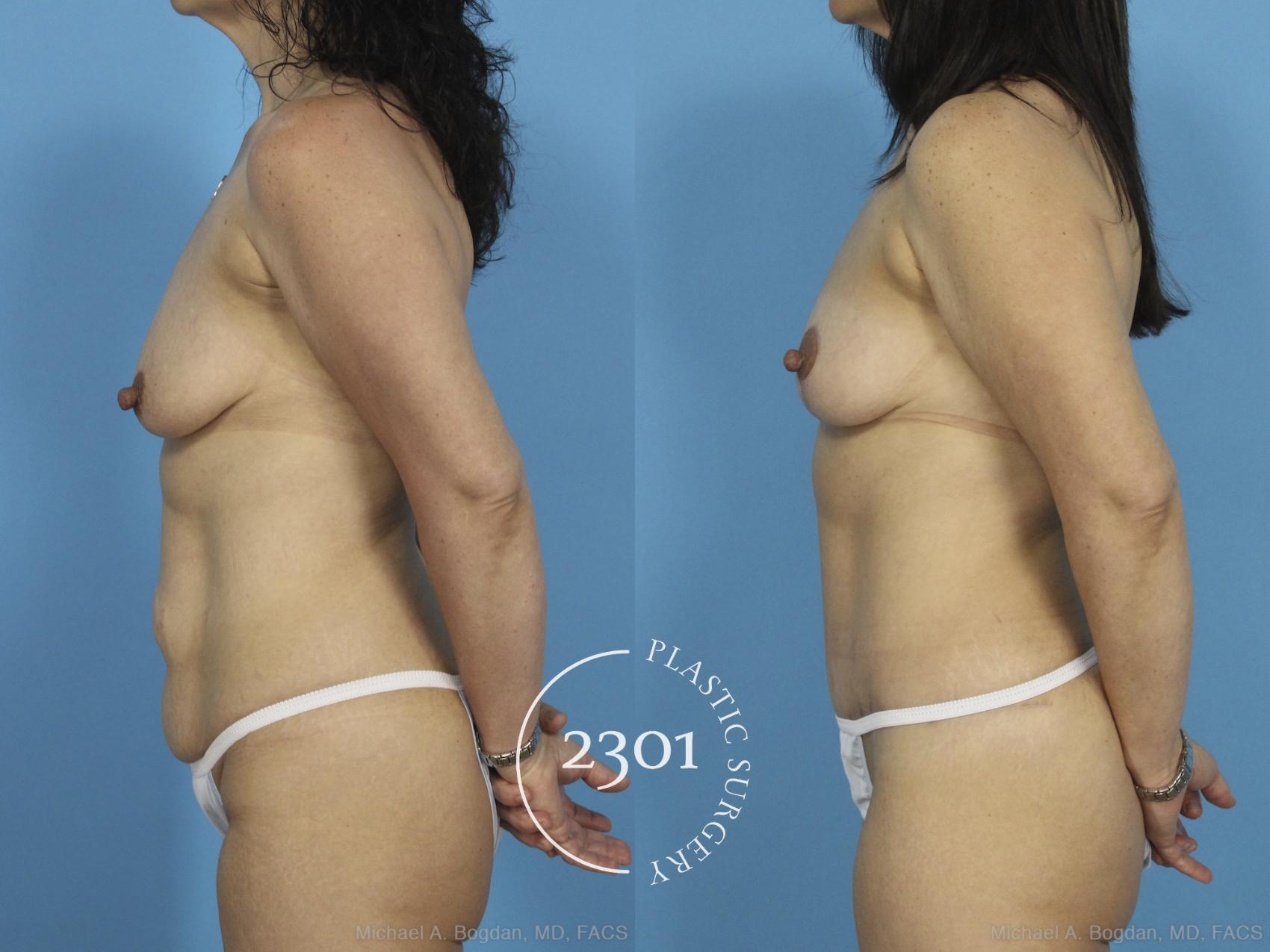Before & After Tummy Tuck Case 435 View #2 View in Fort Worth, Plano, & Frisco, Texas