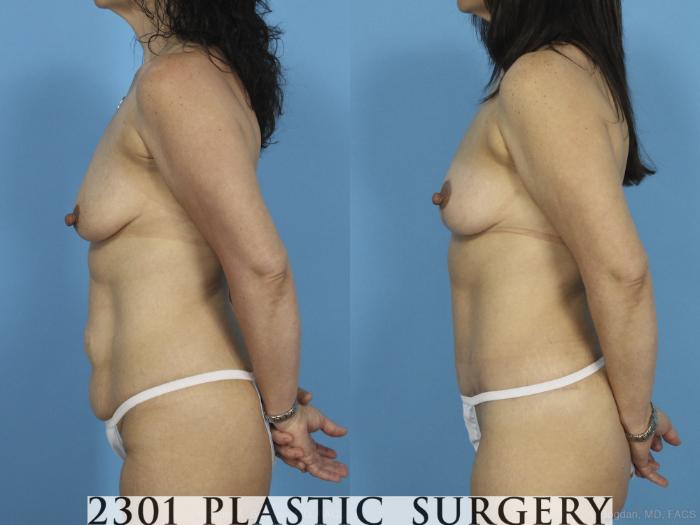 Before & After Breast Lift (Mastopexy) Case 435 View #2 View in Fort Worth, Plano, & Frisco, Texas