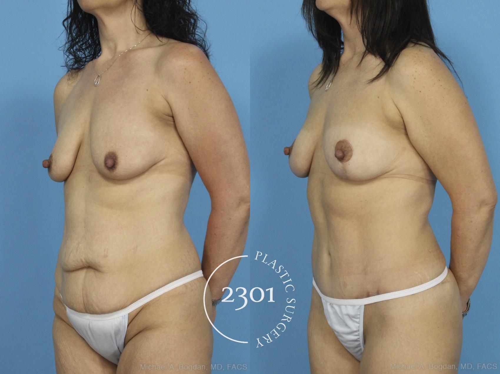 Before & After Tummy Tuck Case 435 View #3 View in Fort Worth, Plano, & Frisco, Texas