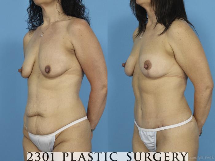 Before & After Breast Lift (Mastopexy) Case 435 View #3 View in Fort Worth, Plano, & Frisco, Texas