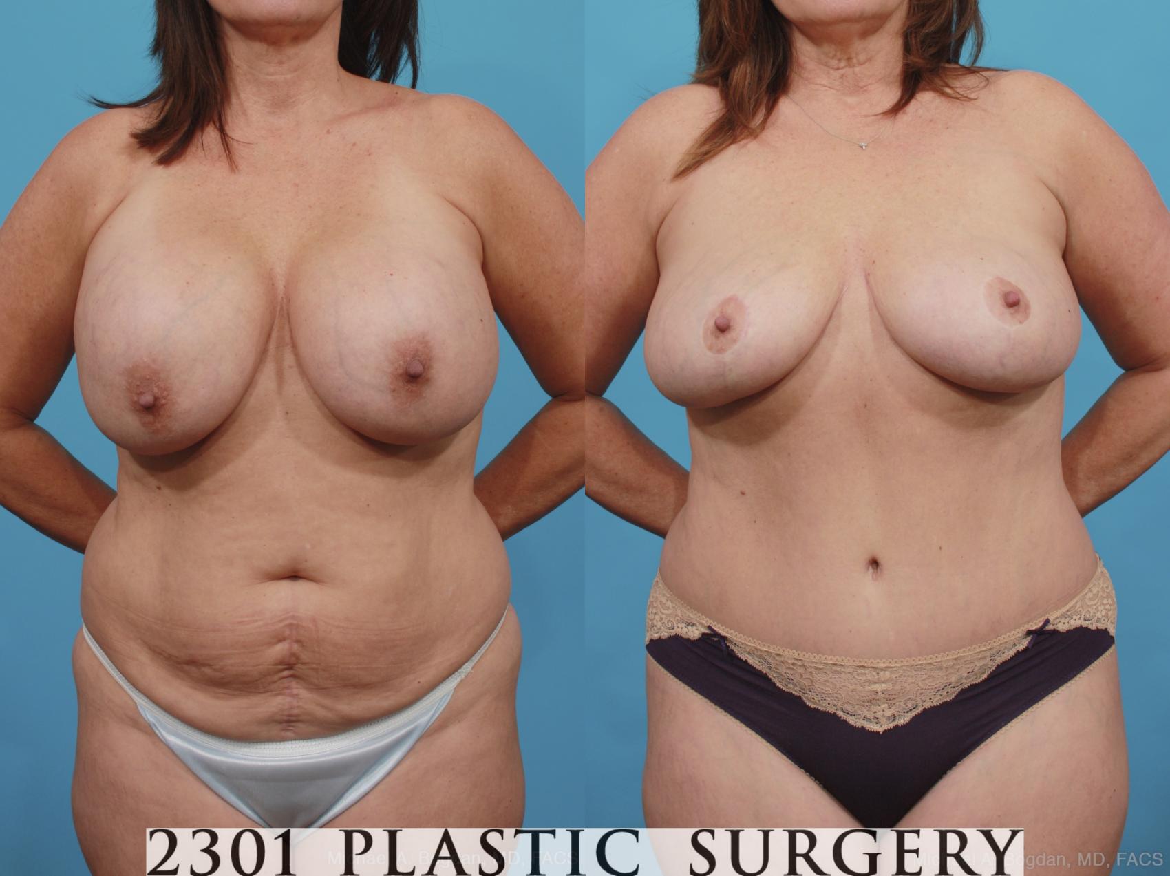 Before & After Breast Lift (Mastopexy) Case 437 View #1 View in Fort Worth, Plano, & Frisco, Texas