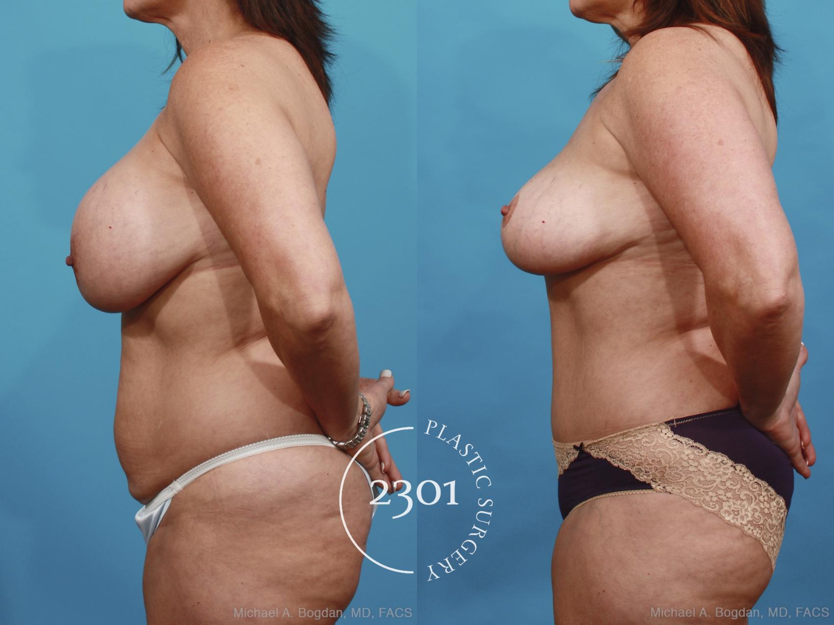 Before & After Breast Augmentation Revision Case 437 View #2 View in Fort Worth, Plano, & Frisco, Texas