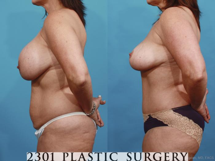 Before & After Mommy Makeover Case 437 View #2 View in Fort Worth, Plano, & Frisco, Texas