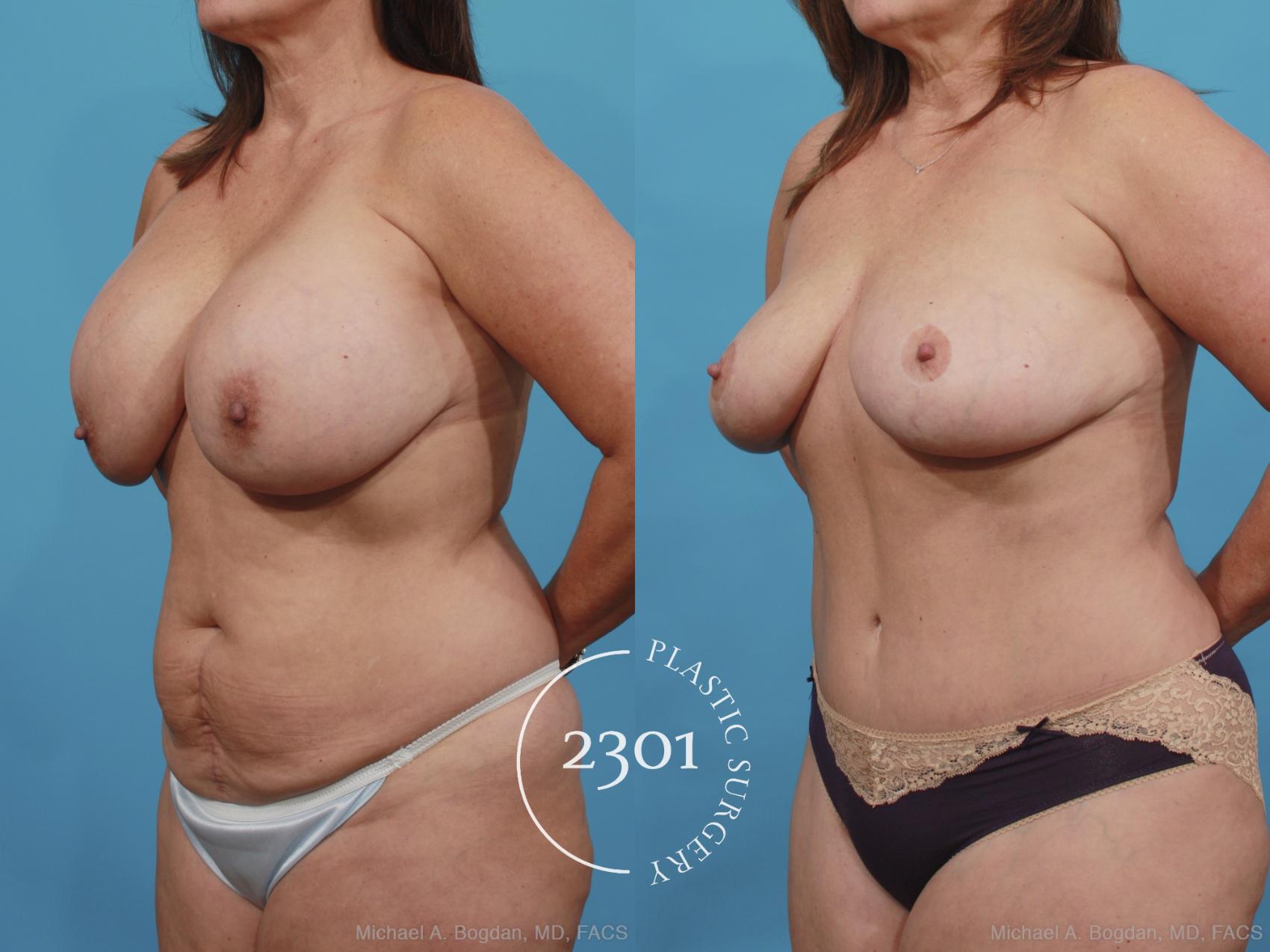 Before & After Breast Augmentation Revision Case 437 View #3 View in Fort Worth, Plano, & Frisco, Texas