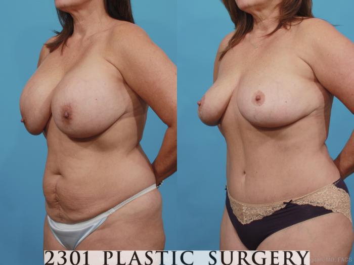 Before & After Breast Lift (Mastopexy) Case 437 View #3 View in Fort Worth, Plano, & Frisco, Texas