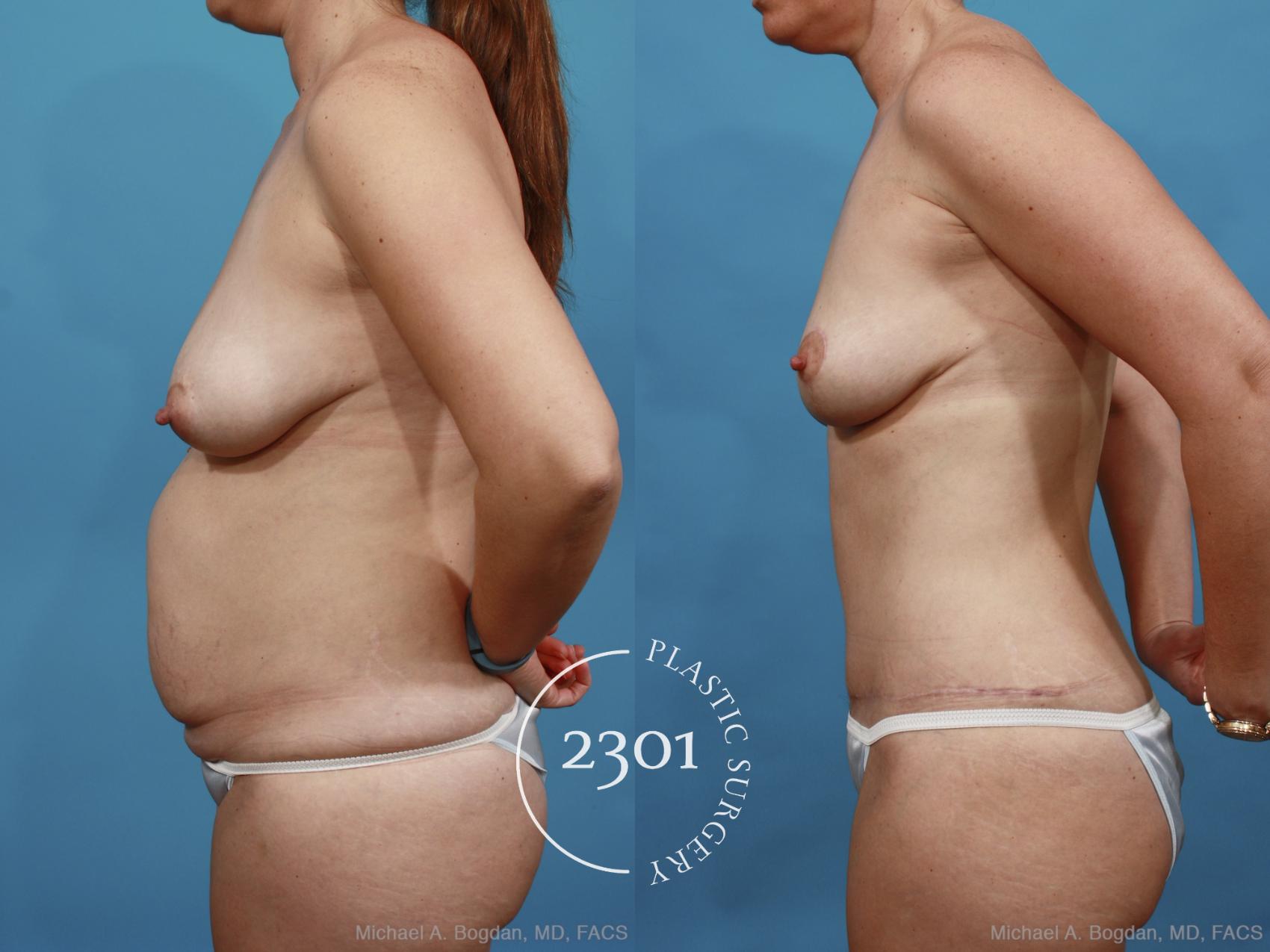 Before & After Breast Lift (Mastopexy) Case 438 View #2 View in Fort Worth, Plano, & Frisco, Texas