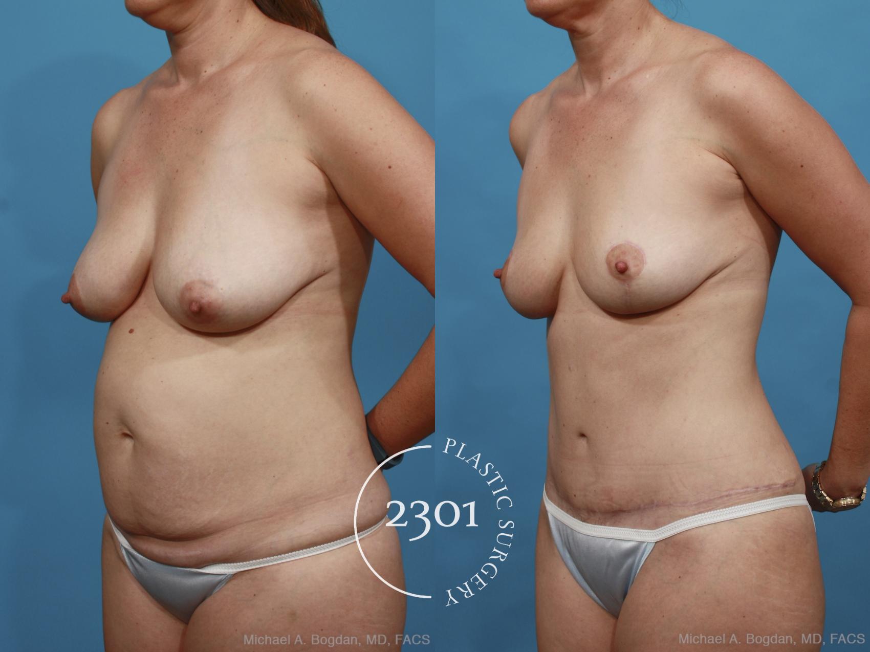 Before & After Breast Lift (Mastopexy) Case 438 View #3 View in Fort Worth, Plano, & Frisco, Texas