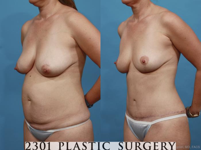Before & After Mommy Makeover Case 438 View #3 View in Fort Worth, Plano, & Frisco, Texas