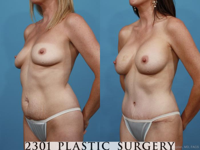 Before & After Mommy Makeover Case 443 View #2 View in Fort Worth & Frisco, Texas